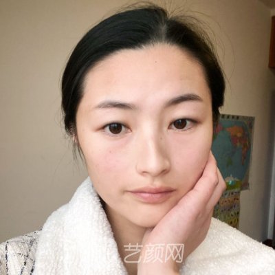 广州美莱陈贵宗割双眼皮好吗?全新体验案例出炉