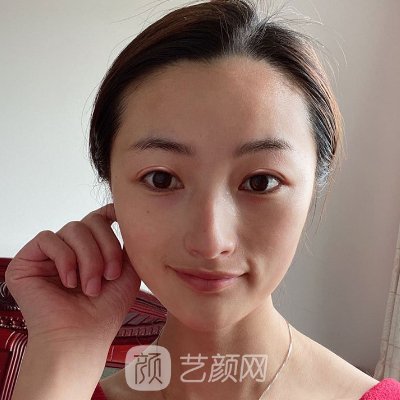 广州美莱陈贵宗割双眼皮好吗?全新体验案例出炉