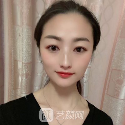 广州美莱陈贵宗割双眼皮好吗?全新体验案例出炉