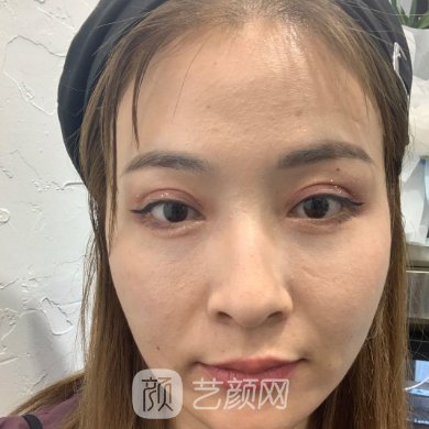 深圳伊婉医疗美容医院口碑好吗?医院除皱抗衰实例曝光