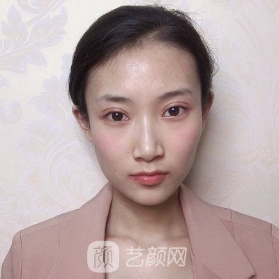 武汉丽婵郭帅医生割双眼皮自然吗?2023全新实例一览