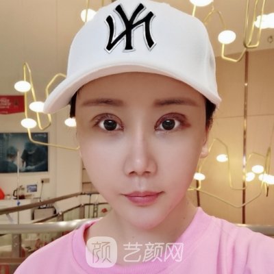 北京叶子整形美容医院正规吗?新版双眼皮整形实例曝光