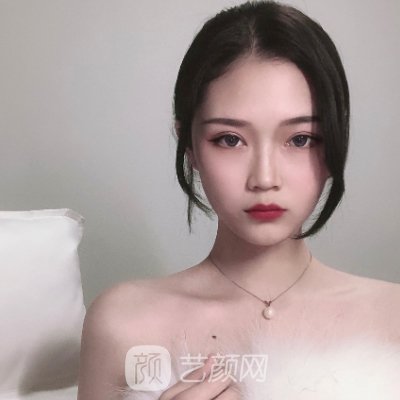 深圳美莱肖峰医生割双眼皮怎么样?全新体验成果图出炉