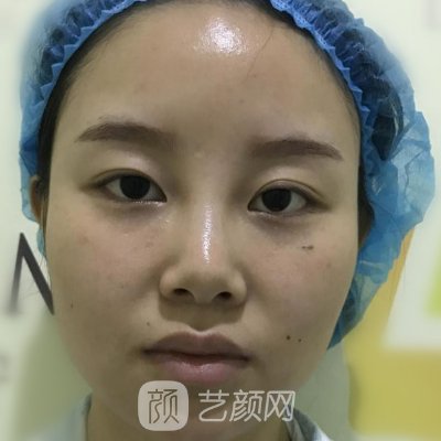 北京米扬丽格做鼻子怎么样?全新体验实例曝光