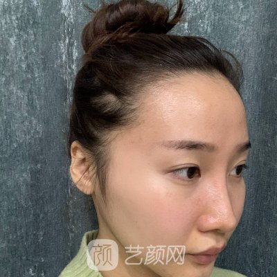 济南海峡美容整形医院植发成果好吗?新版发际线种植实例分享