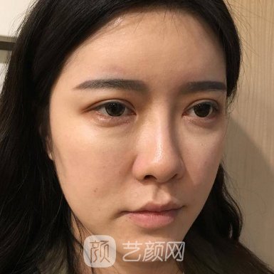 长春中妍奥拉克是正规医院吗?全新隆鼻实例公开