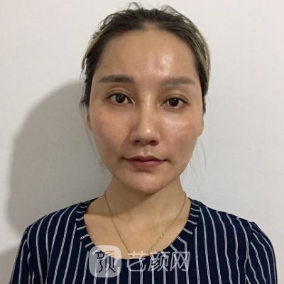 深圳瓷美人整形医院正规吗?新版嫩肤除皱实例分享