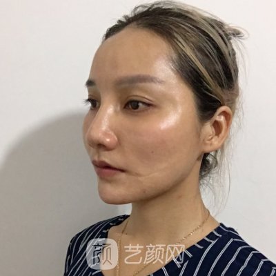 深圳瓷美人整形医院正规吗?新版嫩肤除皱实例分享