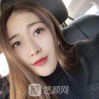 郑州美莱周蔚隆鼻实例，好看的鼻子让我颜值加倍