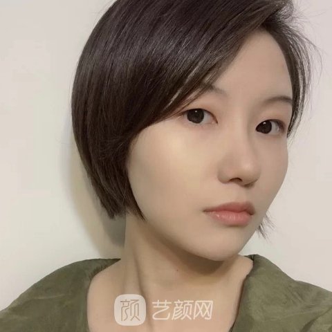 南京光尔美整形医院光子嫩肤实例公开|成果自然美光