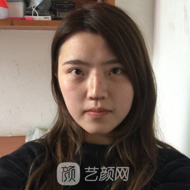 西安美莱美容整形医院正规吗?2023隆鼻实例曝光