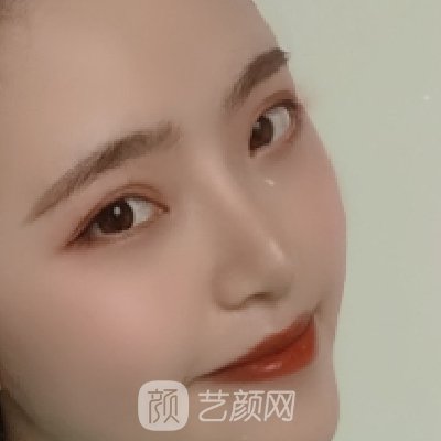 西安美莱美容整形医院正规吗?2023隆鼻实例曝光