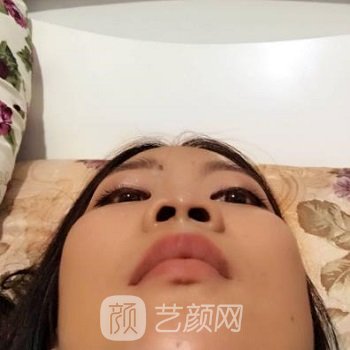 广州李琳隆鼻实例，拥有了挺拔立体的鼻子，变得好看了很多