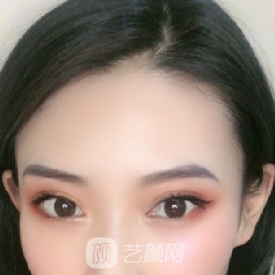 杭州冠美整形医院割双眼皮怎么样?90天体验实例公开