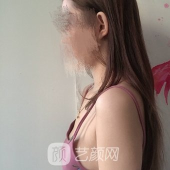 李朕隆胸实例，每次照镜子的时候都要被自己的诱人身材所迷住