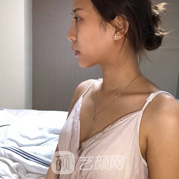 包涛医生隆胸实例，胸变大之后腰都变细了，人也更有气质了