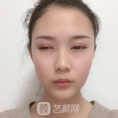 杭州奥美医疗美容医院割双眼皮怎么样?全新体验实例分享