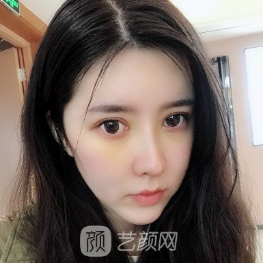 李萍隆鼻成果好吗?医生实力及实例曝光