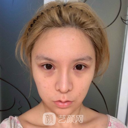 深圳市人民医院面部脂肪填充成果怎么样?2023体验实例公开