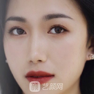 上海华美整形医院口碑怎么样?2023注射除皱实例分享