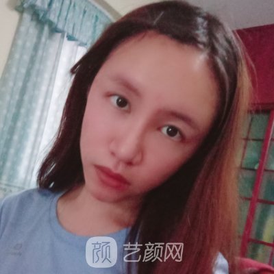 上海美莱整形医院口碑怎么样?全新玻尿酸面部填充实例一览