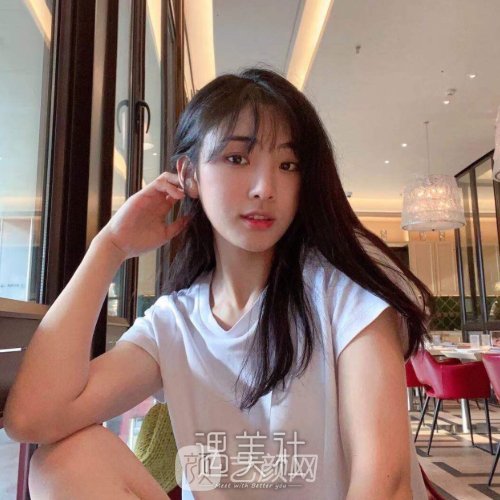 成都美枢郭英宁的双眼皮怎么样？全新体验实例出炉