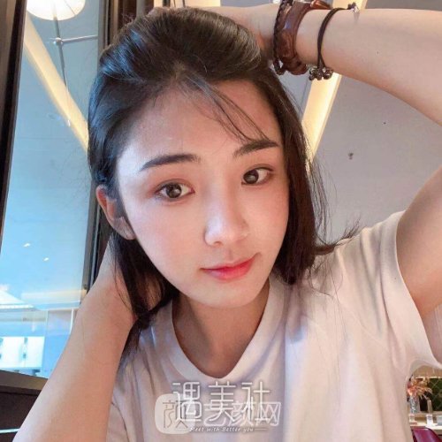 成都美枢郭英宁的双眼皮怎么样？全新体验实例出炉