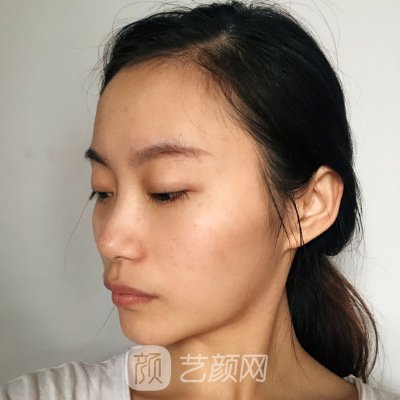 哈尔滨宋明亮修复双眼皮好吗?2023体验实例一览