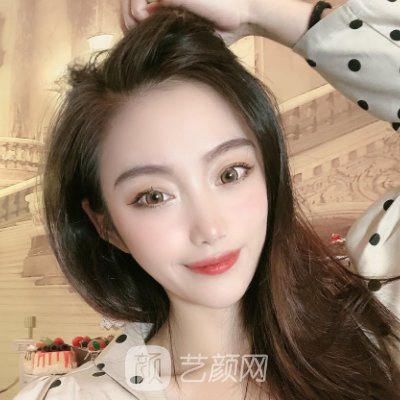 哈尔滨宋明亮修复双眼皮好吗?2023体验实例一览