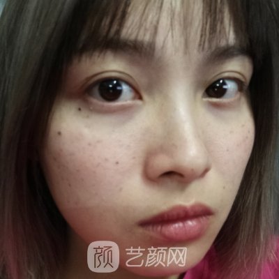 深圳美加美整形医院超皮秒体验实例分享|2023招牌实例出炉