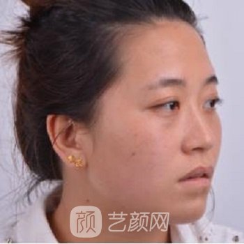 谢立宁隆鼻实例，鼻子立体之后整个人都精致了好多~