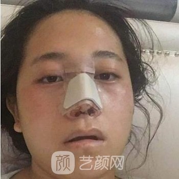 谢立宁隆鼻实例，鼻子立体之后整个人都精致了好多~