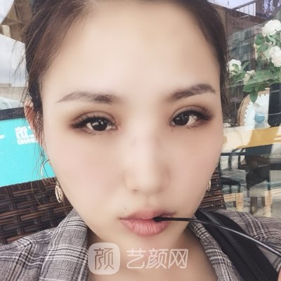 北京画美刘风卓医生割双眼皮怎么样?90天修复实例公开