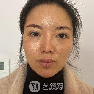 上海伊莱美李旭东面部脂肪填充实例公开｜成果自然美观