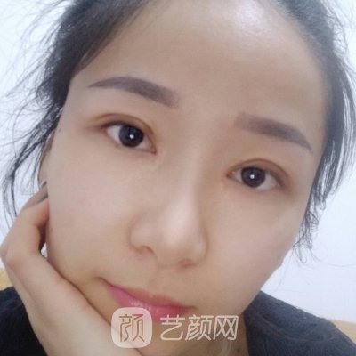 昆明梦想整形美容医院口碑怎么样？2023双眼皮整形实例出炉