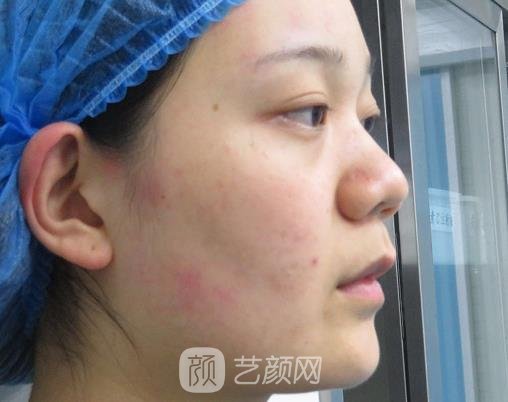 成都铜雀台周柯做鼻子怎么样?90天体验实例曝光