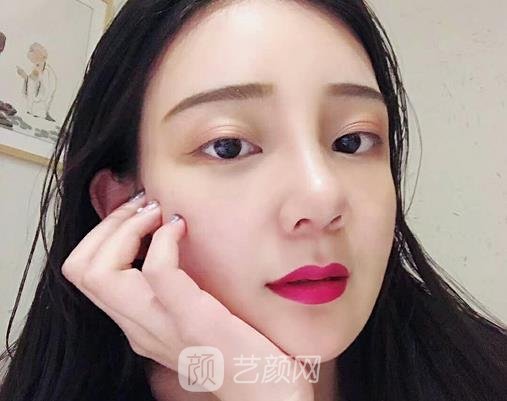 成都铜雀台周柯做鼻子怎么样?90天体验实例曝光