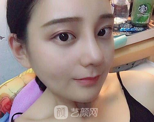 成都铜雀台周柯做鼻子怎么样?90天体验实例曝光