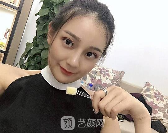 成都铜雀台周柯做鼻子怎么样?90天体验实例曝光