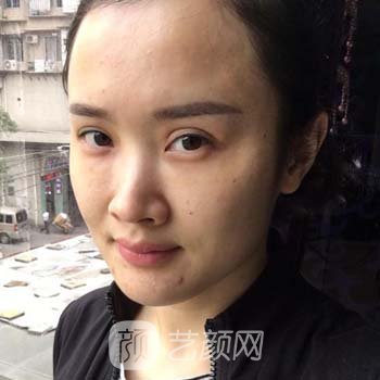 成都东篱李竞隆鼻实例，鼻子的高挺精致，变成迷人小仙女