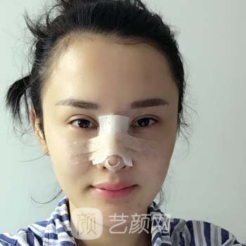 成都东篱李竞隆鼻实例，鼻子的高挺精致，变成迷人小仙女