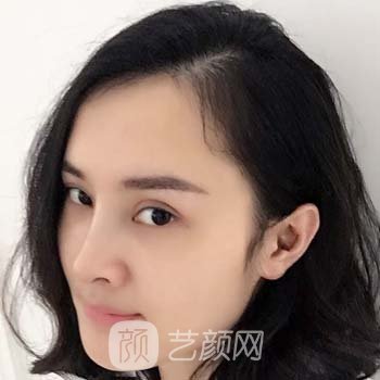 成都东篱李竞隆鼻实例，鼻子的高挺精致，变成迷人小仙女