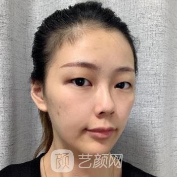 邵阳中心医院整形美容科做双眼皮多少钱？医生介绍+实例