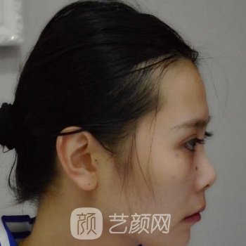 桂林华美整形美容医院怎么样？医生介绍+隆鼻实例对比图