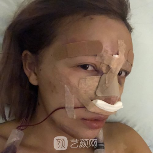 济南艺星整形美容医院隆鼻实例公开｜成果自然美观