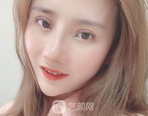 上海娜美整形医院口碑怎么样？2023隆鼻实例出炉