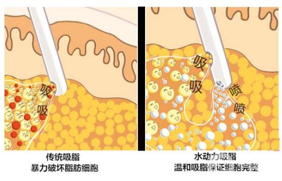 水动力吸脂、雷射溶脂、隆胸，三下合一雕塑性感曲线