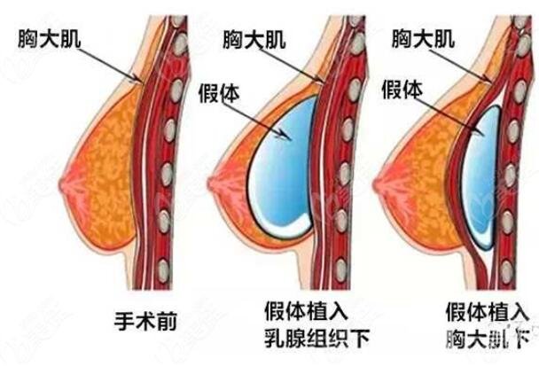 水动力隆胸存活率达8成?