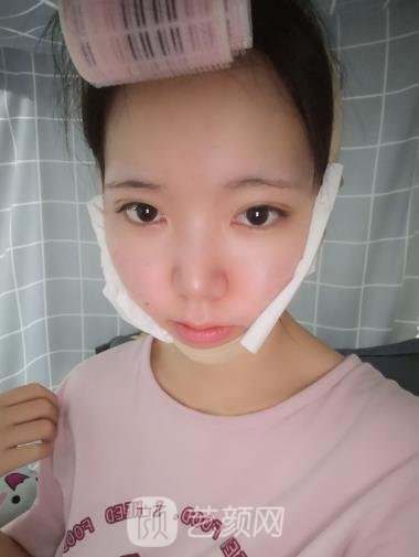 上海杨君毅磨骨实例,大方脸变成标准瓜子脸~