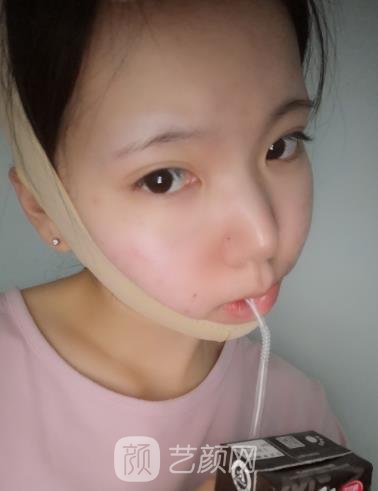 上海杨君毅磨骨实例,大方脸变成标准瓜子脸~